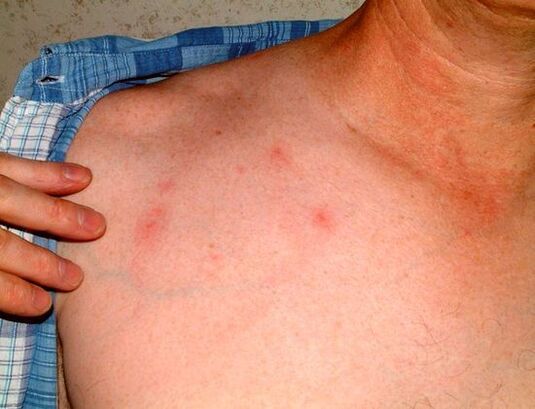 síntomas de parasitos baixo a pel